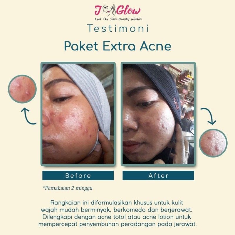 jglow skincare paket ekstra acne / J-glow skincare paket ekstra acne / j glow skincare ekstra acne
