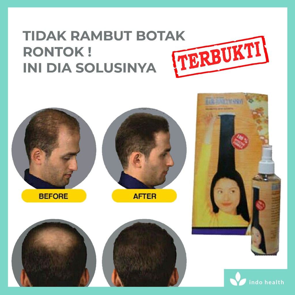 HAIR / TONIC / RAMBUT / PENUMBUH RAMBUT / OBAT PENUMBUH RAMBUT / OBAT PENUMBUH RAMBUT BOTAK