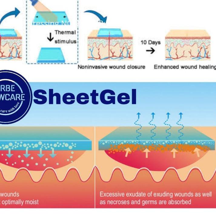 ⇦ SheetGel hidrogel dressing 10x10 cm erbemowcare ,luka bakar , hidrogel lembaran Urgotul , luka bak