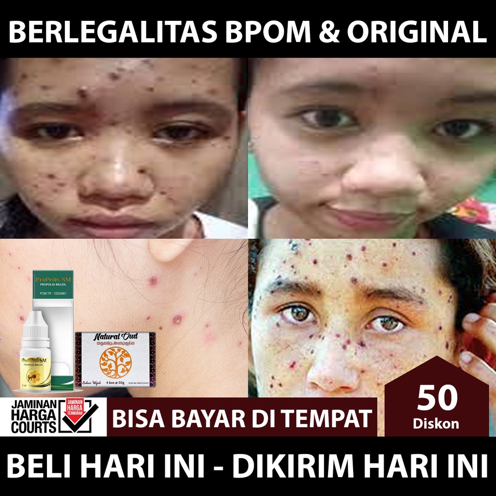 Obat Penghilang Bekas Cacar Di wajah - Obat Bekas Cacar Di Pipi, Di Dahi, Di Muka, Penghilang Bekas Cacar Yang Sudah Menghitam Di Wajah, Koreng Hitam Di Wajah, Penyamar Bekas Luka Cacar Di Wajah, Menyamarkan Bekas Luka Di Wajah, Obat Cacar Api, Cacar Air