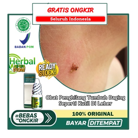 Obat Penghilang Tumbuh Daging Seperti Kutil Di Leher | Salep Cair Menghilangkan Kutil Di Leher - Pap