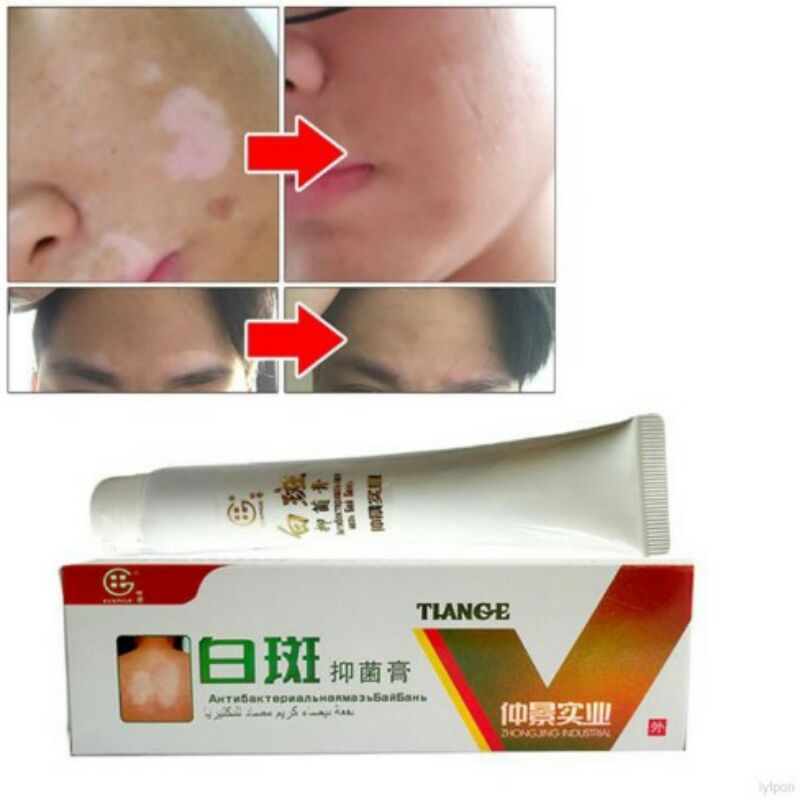 Original Salep Vitiligo Bercak Putih Bahan Herbal