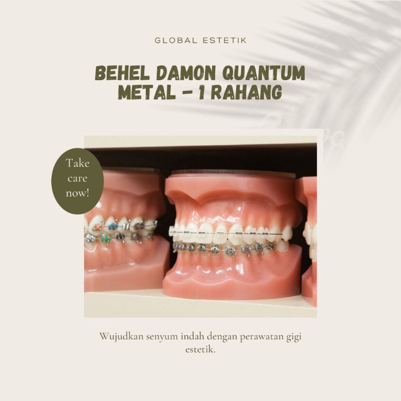 Behel Damon Metal -1Rahang
