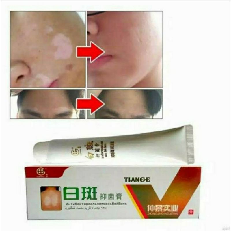 Obat Penyakit Kulit Vitiligo Salep Cream Untuk Belang Putih Dikulit