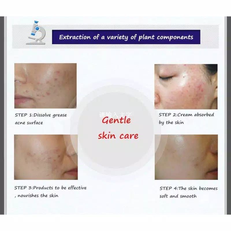 Medan Termurah Krim penghilang jerawat pure skin acne removal