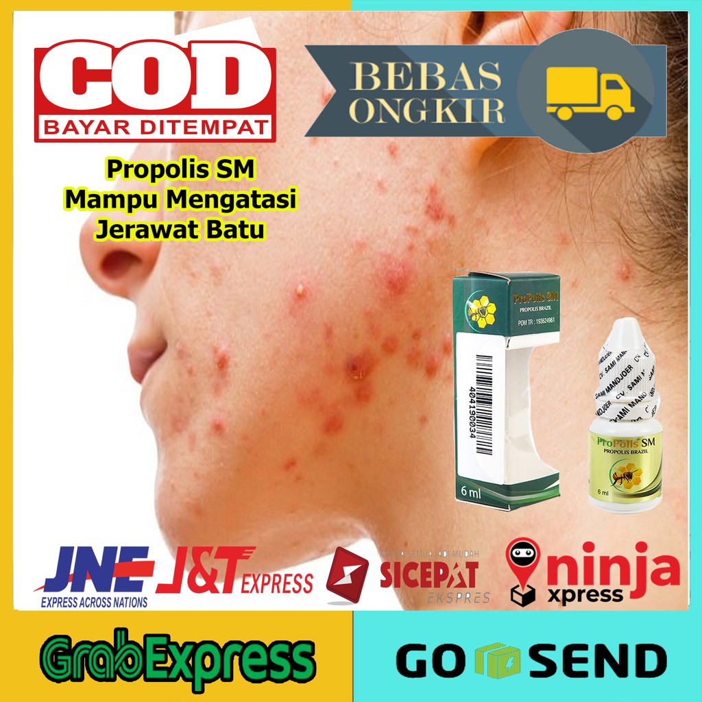 obat Penghancur Jerawat Batu, Jerawat Wanita, Jerawat Pria, Jerawat Di Punggung Propolis SM