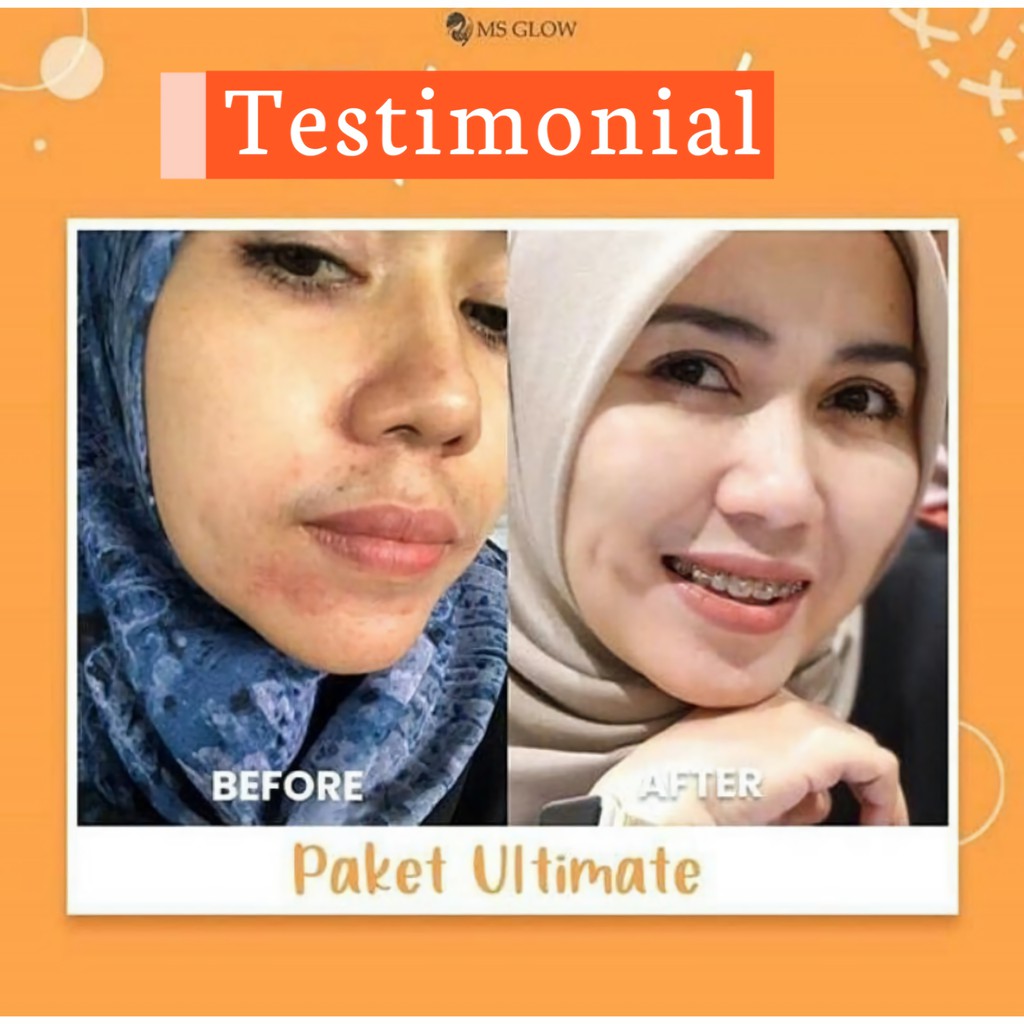 MS Glow Original Whitening Acne Luminous Ultimate Series - Paket MS Glow Whitening Acne Luminous Ultimate Original - Skincare MS Glow Paket Whitening Acne Luminous Ultimate Ori Original - MS Glow Beauty Official Store Resmi Cikarang Bekasi Bandung Jakarta-4