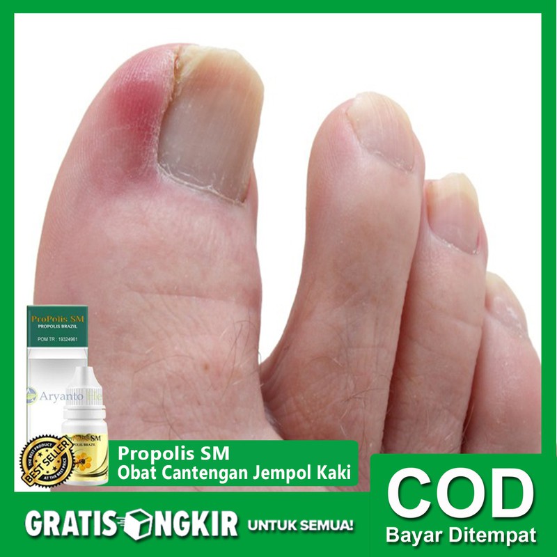 Obat Cantengan Jempol Kaki Propolis Sm Brazilian Shopee Indonesia