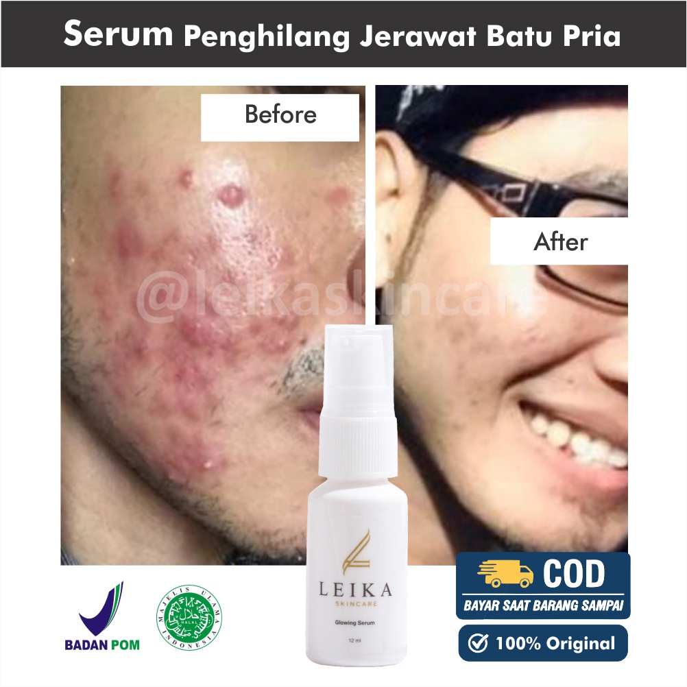 Serum Acne Penghilang Jerawat Pria Serum Jerawat Penghilang Jerawat Batu Serum Jerawat Dan Bekas Jer