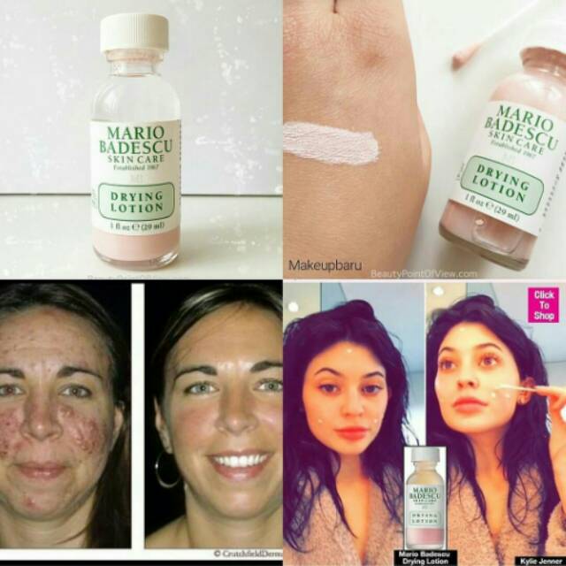 Mario badescu acne drying lotion