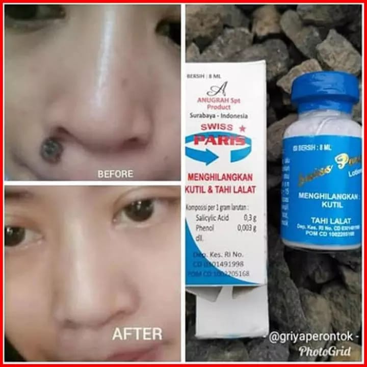 SwissParis Lotion - Lotion Penghilang Kutil - Obat Penghilang Kutil - Obat Perontok Kutil Paling Ampuh Original - Obat Lotion Penghilang Perontok Kutil Kelamin dan Mata Ikan - Obat Penghilang Mata Ikan - Swiss Paris Original Lotion Penghilang Kutil