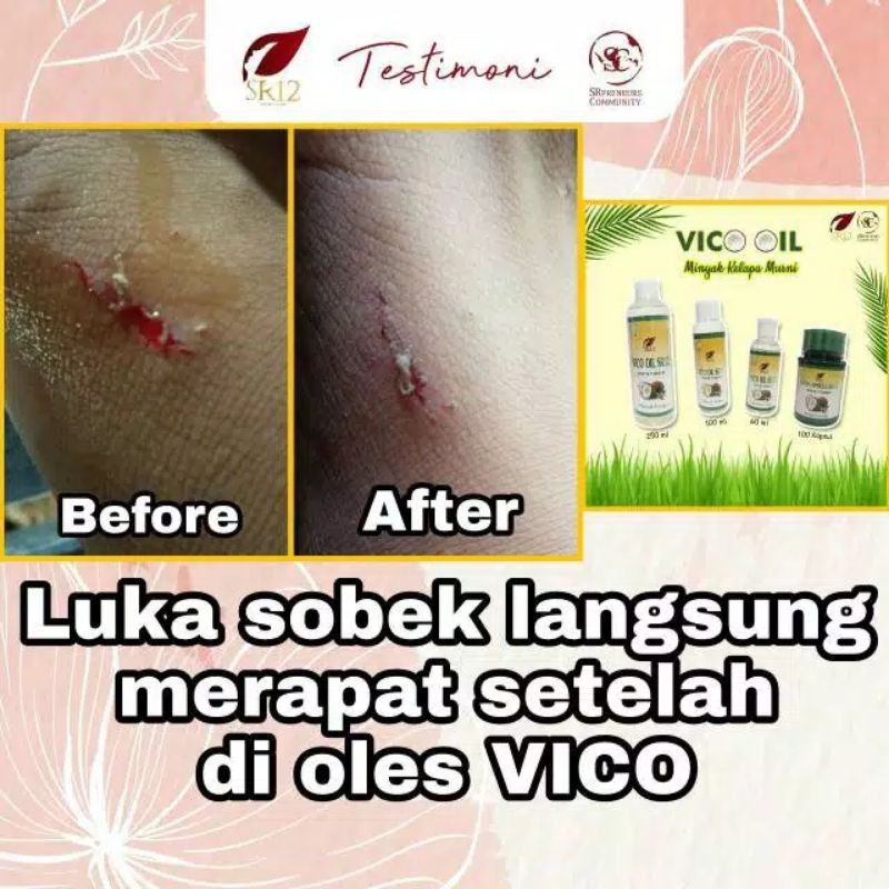 

Minyak VICO/minyak ajaib/buat luka/buat jerawat