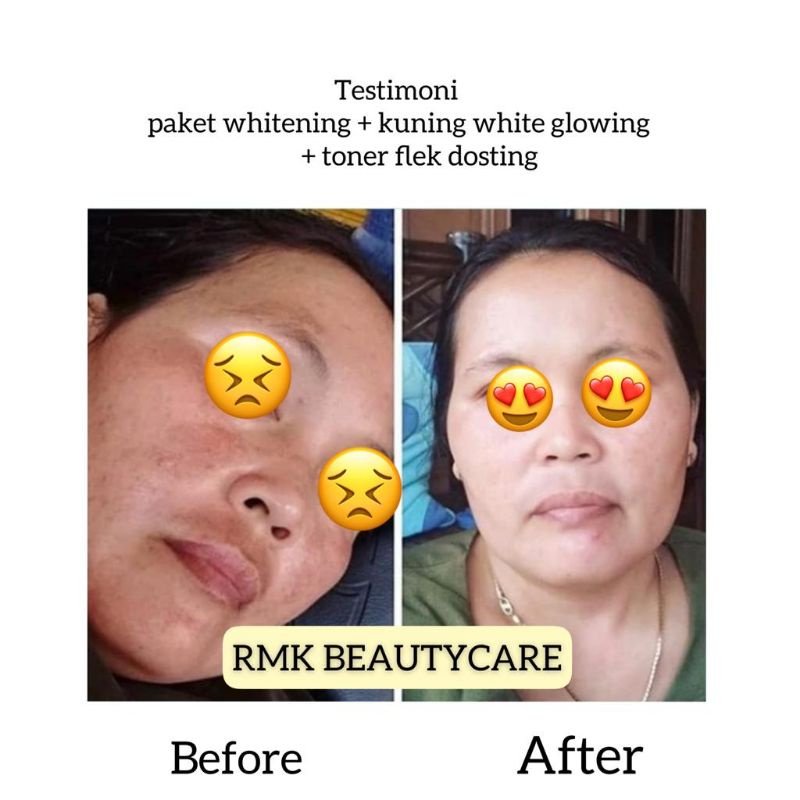 salep flek dosting / salep flek bandel / toner flek dosting / cream flek wajah susah putih / fleksol flek solution rmk