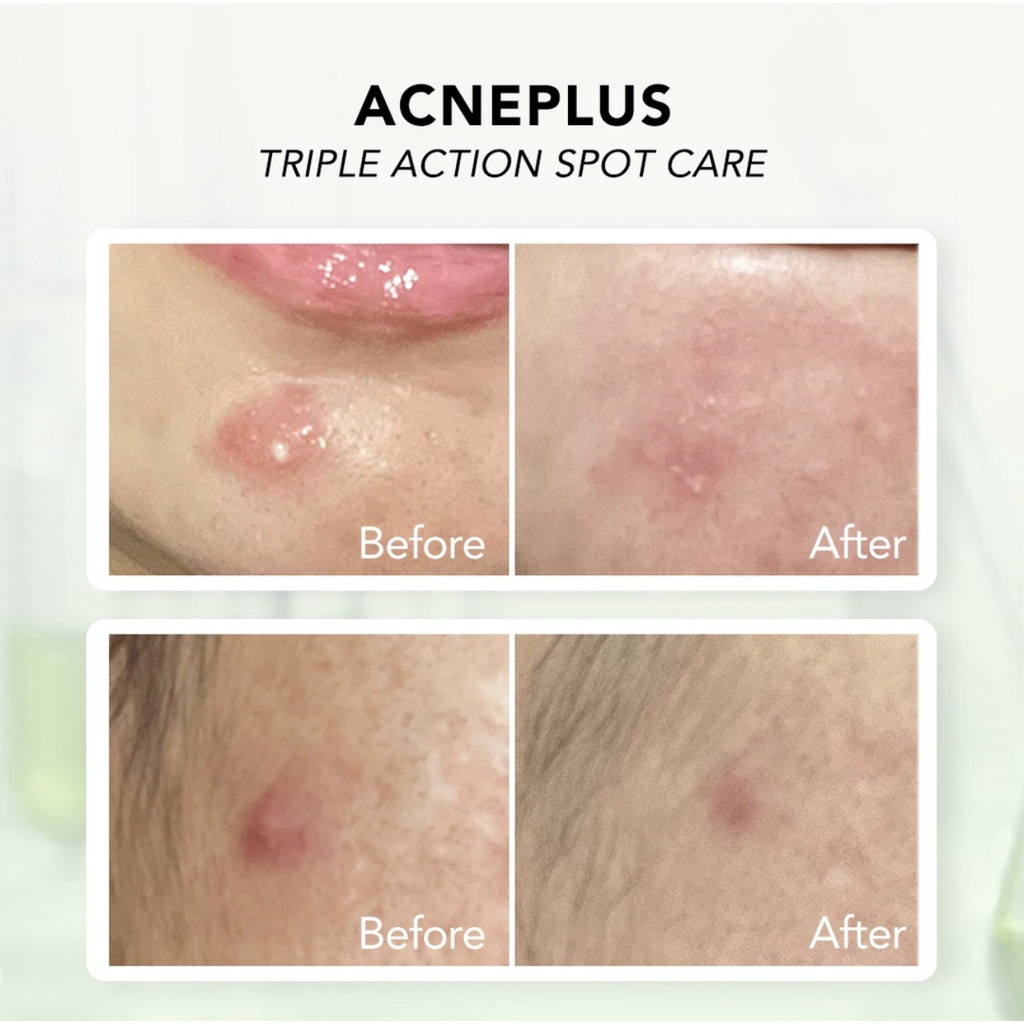 YOU Acne Plus Triple Action Spot Care 15gr Acneplus