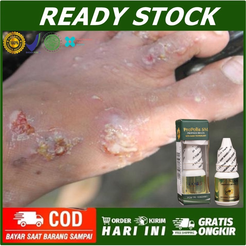 Obat Gudig/Gudik, Borok Bernanah Obat Cenang Bernanah Benjolan Bernanah Gatal Menahun Salep Scabies,