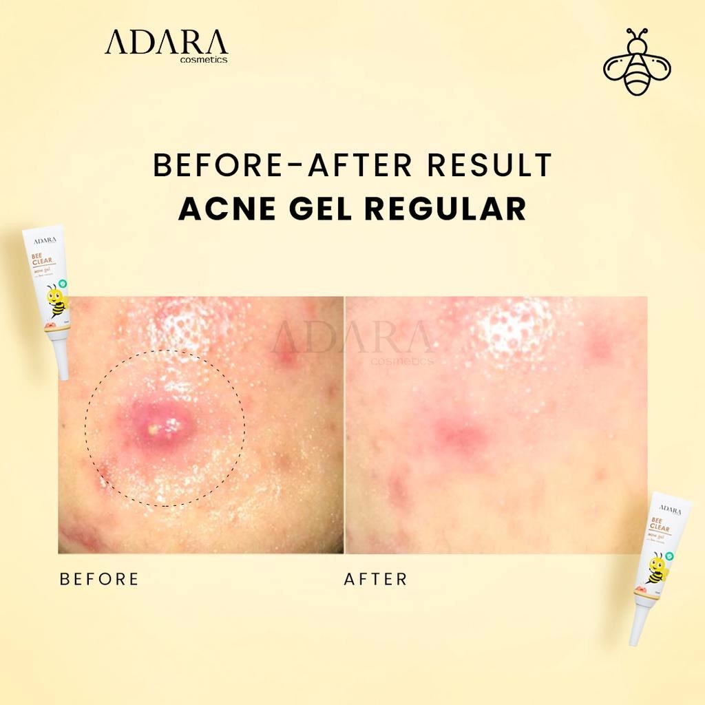 ★ BB ★  ADARA Bee Clear Acne Gel - Extra Formula