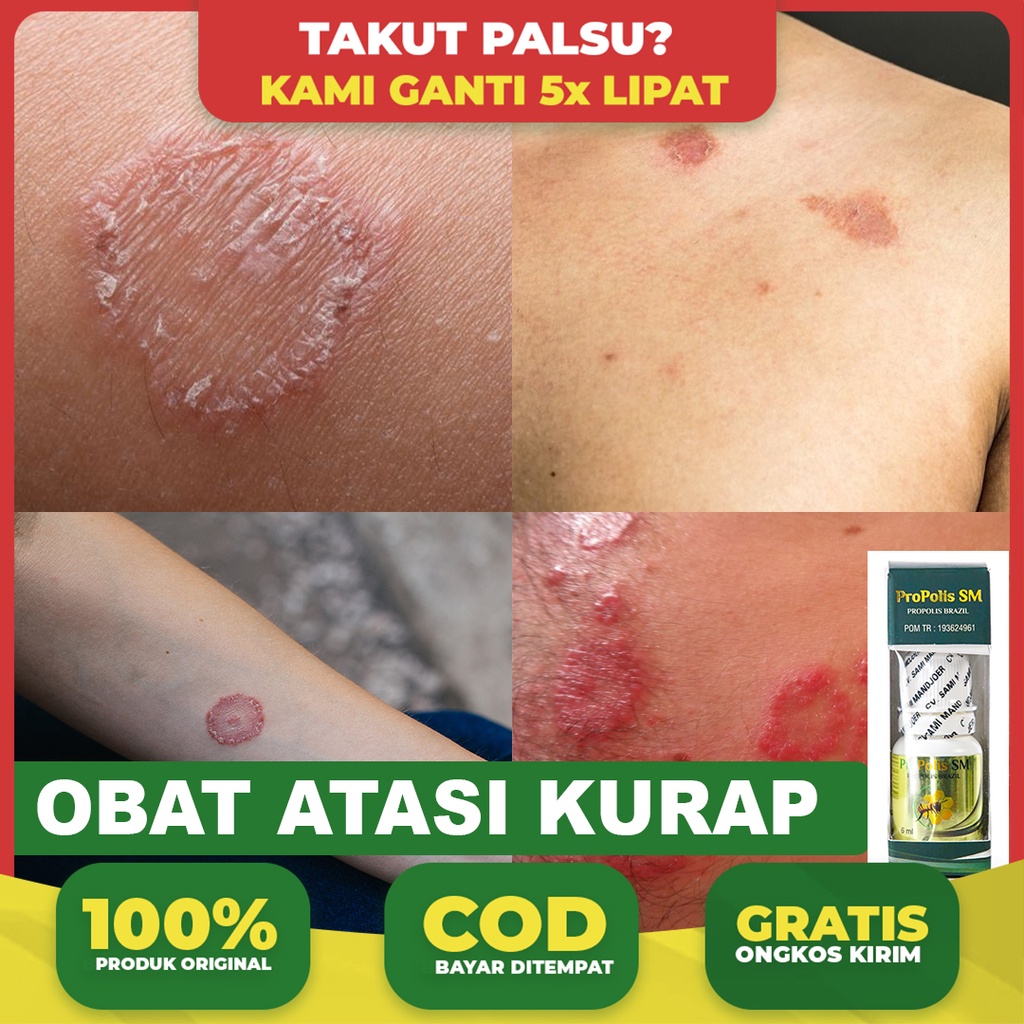 Obat Kurap, Hapuran, Gatal Gatal, Herpes, Propolis Sm 100% Alami Bisa COD