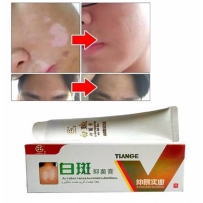 TIANGE Salep Vitiligo Bercak Putih Bahan Herbal Tiange Cream Original Ampuh