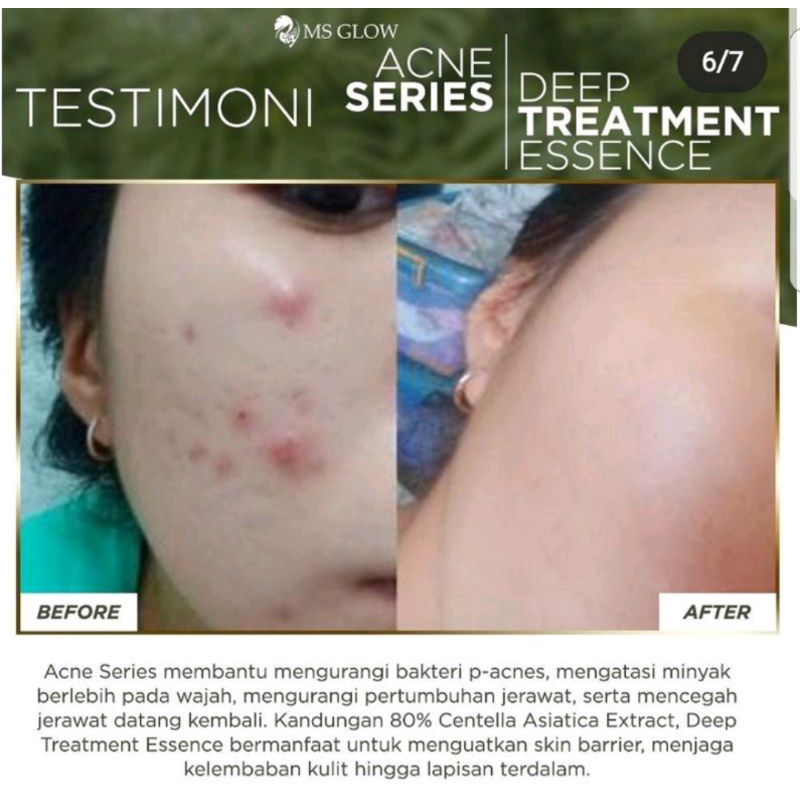 Paket Acne + Deep Treatment Essence Centela MS GLOW.