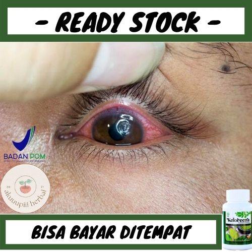 Obat Alami Ulkus Kornea, Obat Radang Lapisan Luar Mata, Obat Skit Mata, Obat Untuk Penyakit Ulkus Ko