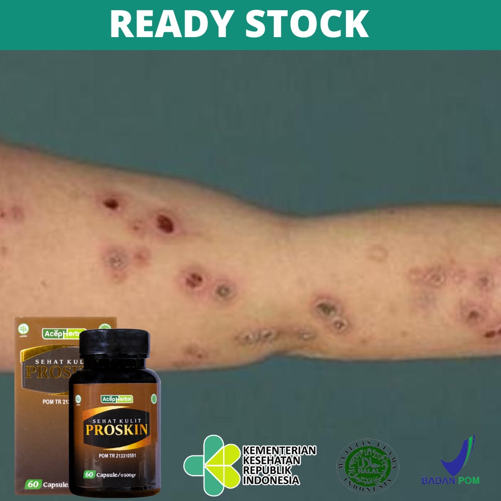 Obat Gatal Prurigo, Obat Darah Manis, Obat Bintil-Bintil Bernanah, Gatal Bernanah, Obat Kulit Gatal 