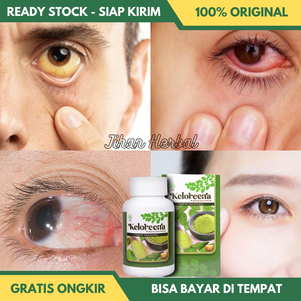 Obat Mata Kuning Mata Berlemak Merah Iritasi Pterygium Mata Minus Rabun Katarak Floaters Silinder He