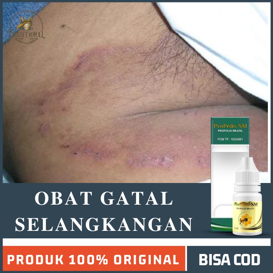 Jual Obat Gatal Selangkangan Pria di Apotik, Tinea Cruris, Kurap, Eksim