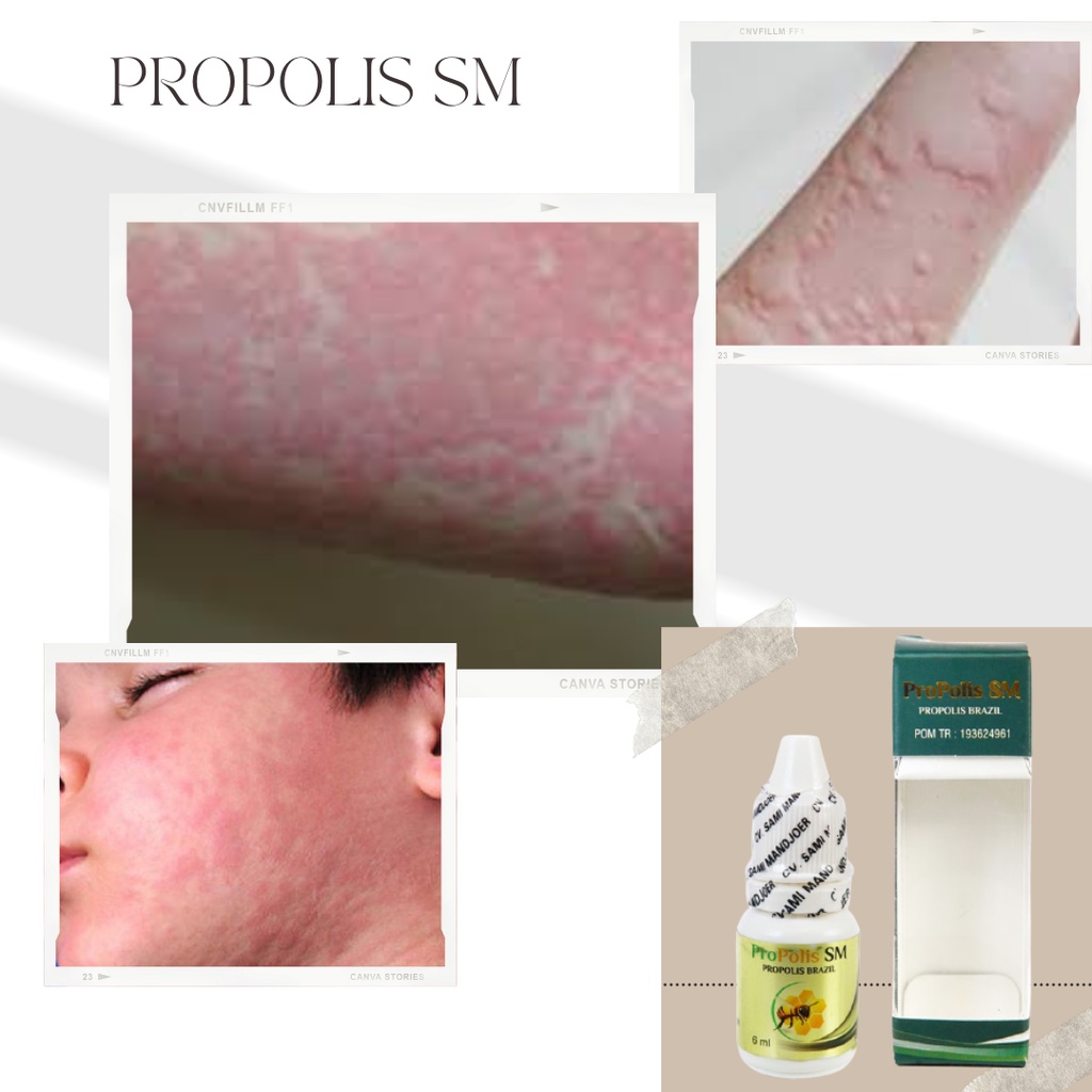 obat gatal kulit - obat biduran - obat kaligata - obat alergi gatal kulit - obat kulit - obat gatal 