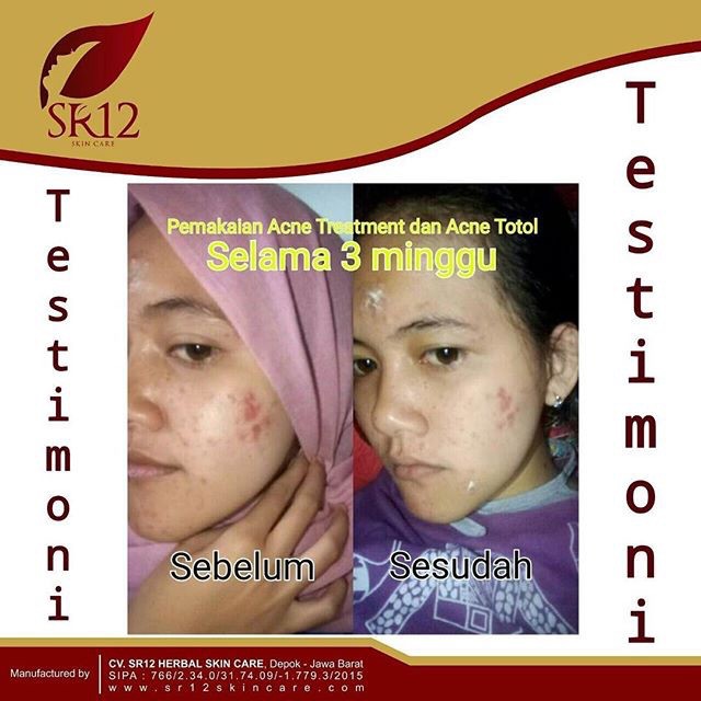 SR12 ACNE TREATMENT CREAM KRIM JERAWAT MERADANG &amp; MEMBANDEL AMPUH HILANGKAN JERAWAT