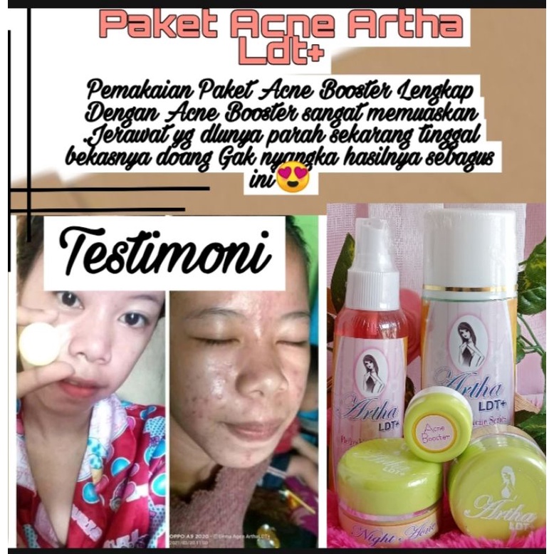 Paket Acne Artha ldt/ Cream Jerawat Artha ldt / Cream penghilang Jerawat Artha Ldt
