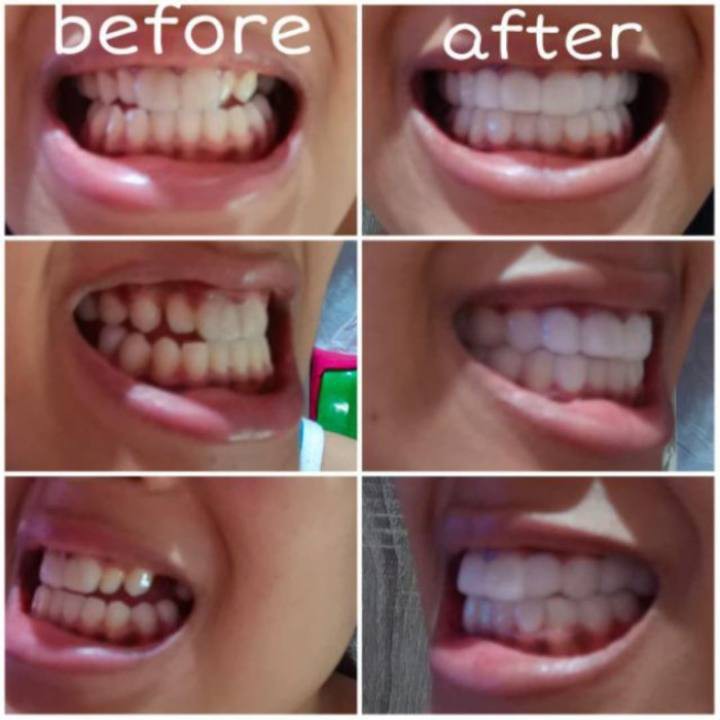 Penutup Gigi Berlubang Super Kuat 100 Original Penambal Gigi Berlubang Gigi Palsu Atas Bawah Murah Indonesia