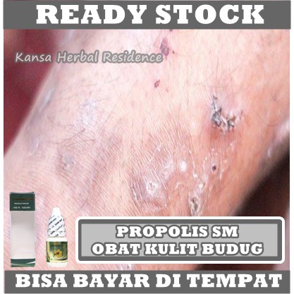 Obat Kaki Budug, Obat Penghilang Bekas Budug, obat Gudig Gudik, Obat Borok Di Kaki Dan Tangan, Obat Budug Di Tangan Dan Kaki, Obat Scabies Dengan Propolis SM Brazil