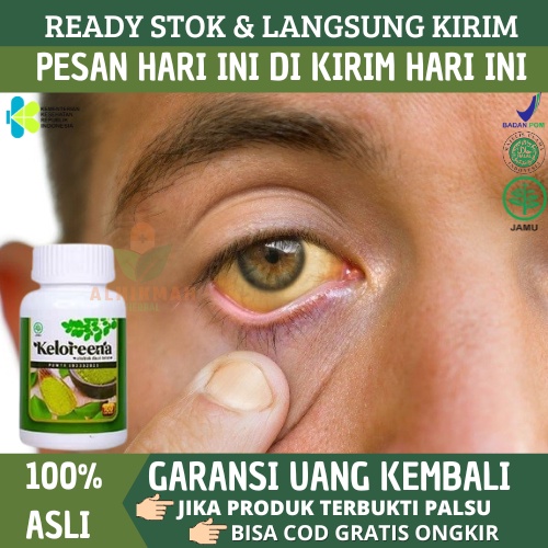 Obat Mata Kuning, Mata Kuning, Pembersih Mata Kuning, Obat Menghilangkan Mata Kuning, Obat Mata Berl