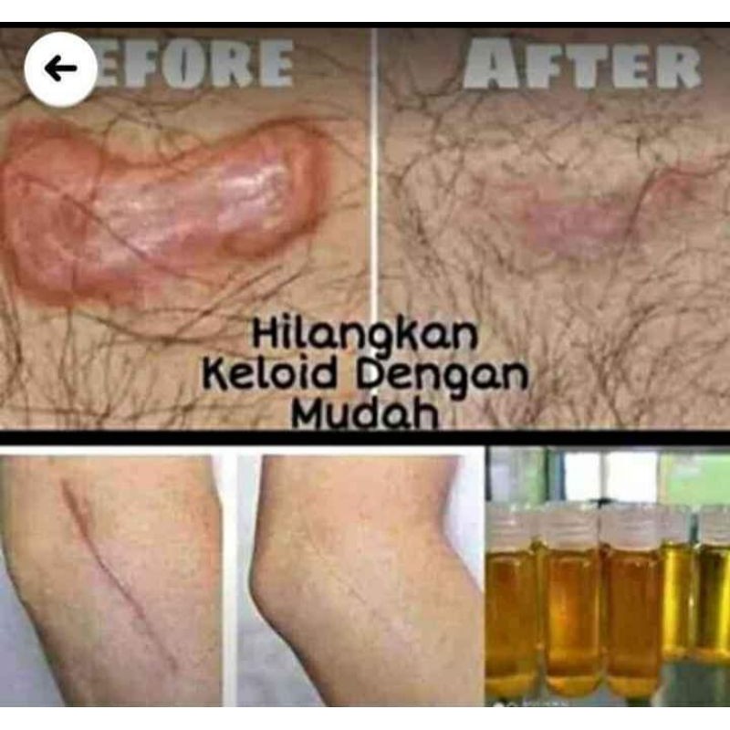 terampuh atasi keloid