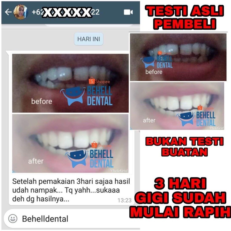 PERAPIH GIGI BEHELLDENTAL ORIGINAL / ALAT PELURUS TANPA BEHEL / TEETH TRAINER RETAINER ALIGNMENT 100% ORI ASLI - Dental Perata Gigi