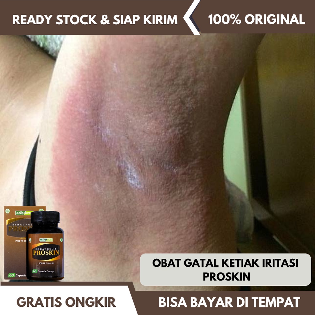 Obat Iritasi Ketiak Gatal, Obat Ketiak Gatal Hitam, Obat Kulit Ketiaki Gatal Ruam Merah Akibat Jamur