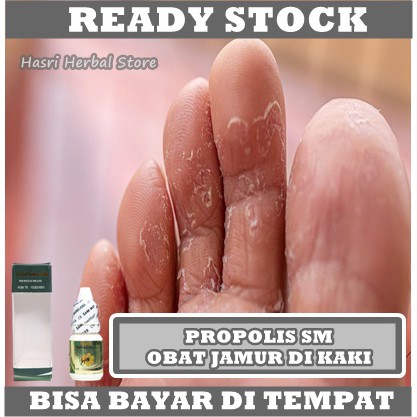 Obat Jamur di Kaki 100% Alami, Obat Infeksi Jamur Di Kaki, Obat Gatal Jamur Air Di Kaki, Obat Kaki Atlet, Obat Gatal Jamur Kulit Kaki, Obat Oles Jamur Kulit Jari, Obat Kutu Air di Kaki, Obat Kaki Gatal Karena Jamur dengan Propolis SM