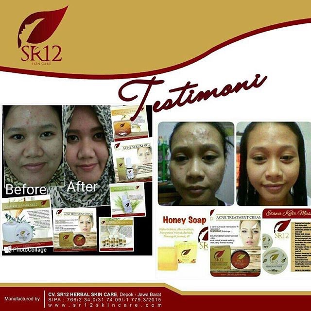 SR12 ACNE TREATMENT CREAM KRIM JERAWAT MERADANG &amp; MEMBANDEL AMPUH HILANGKAN JERAWAT