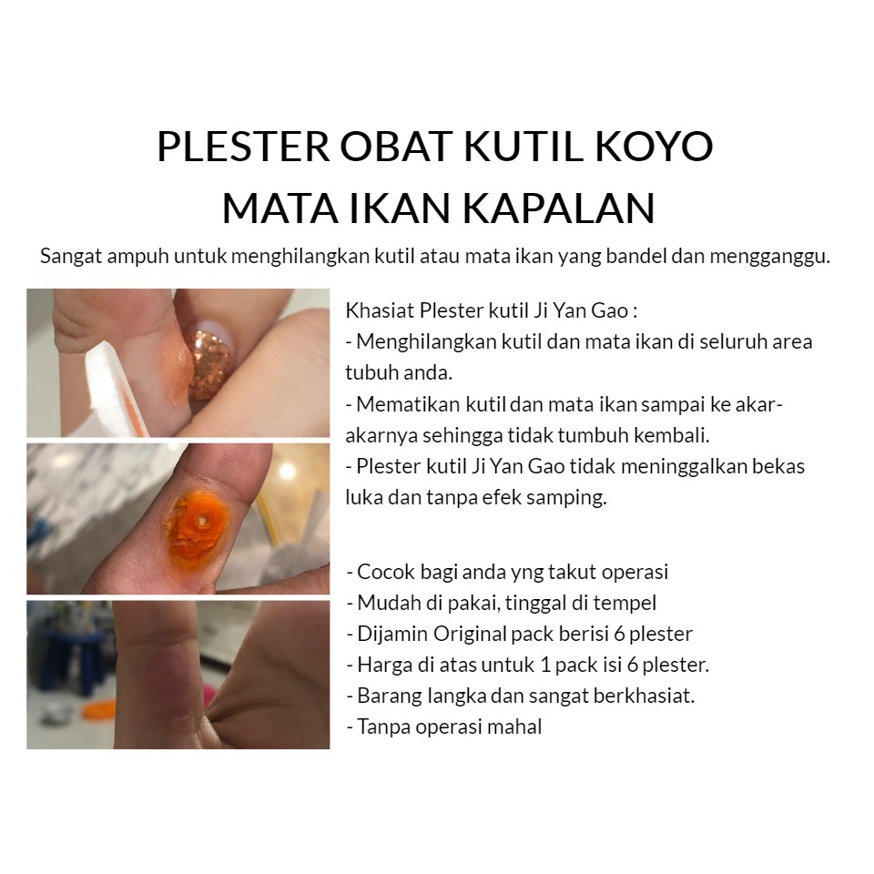 Plester Kutil Mata Ikan Kaki Kapalan Ji Yan Gao Obat Kutil Mata Ikan Kaki Kapalan [1 Box Isi 6Pcs]