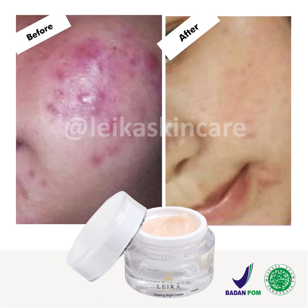 Asli! Penghilang Jerawat dan Bekas Jerawat Pria Wanita Paling Ampuh Permanen Penghilang Jerawat / Jerawat Pasir / Jerawat Batu / Bruntusan  - Leika Skincare Glowing Night Cream 100% Resmi BPOM Halal