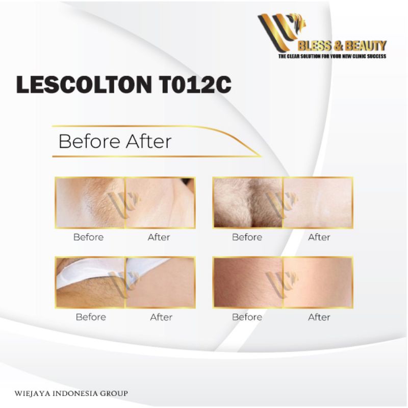 Alat Ipl Ice Cool Penghilang Bulu Permanent Laser Ipl Terbaru ipl hair removal lescolton