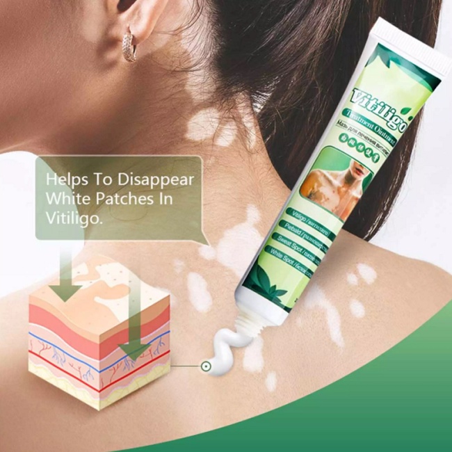 Cream Penghilang Vitiligo Salep Vitiligo Bintik Putih