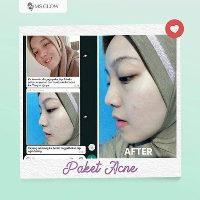 MS GLOW Paket Acne (untuk kuLit wajah berjerawat)