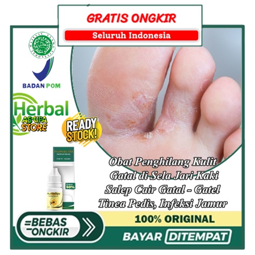 Obat Penghilang Kulit Gatal di Sela Jari Kaki | Salep Cair Gatal - Gatel Tinea Pedis, Infeksi Jamur,