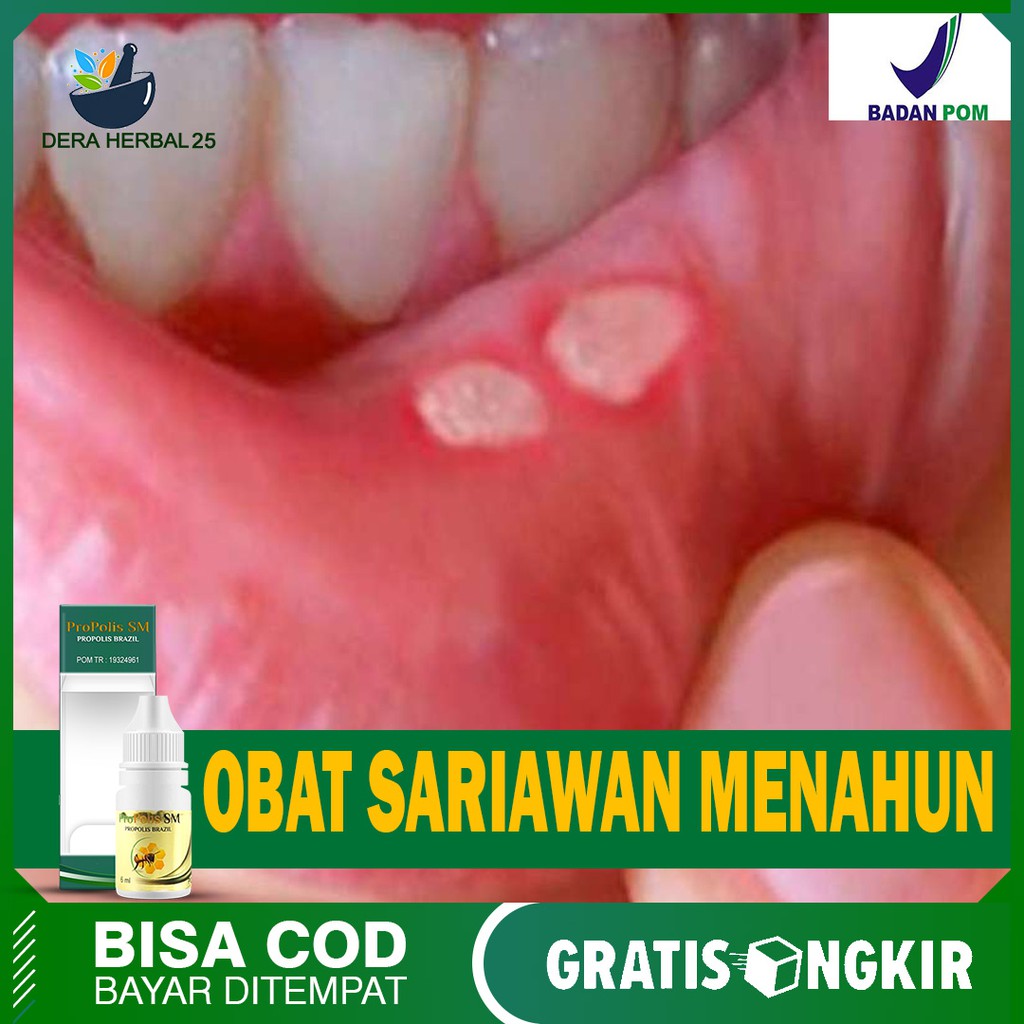 Obat Sariawan - Bau Mulut - Bibir Pecah Pecah - Sariawan Akut - Menahun Herbal Terlaris Propolis SM