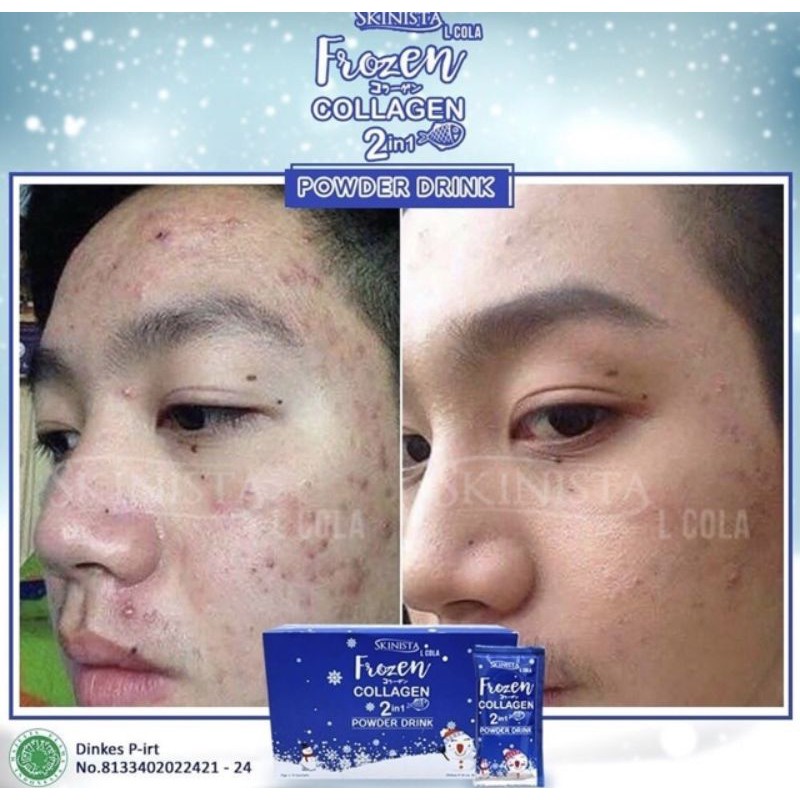 COLLAGEN BUBUK PEMUTIH TUBUH FROZEN COLLAGEN 2IN1 POWDER DRINK - COLLAGEN PENYEMBUH JERAWAT