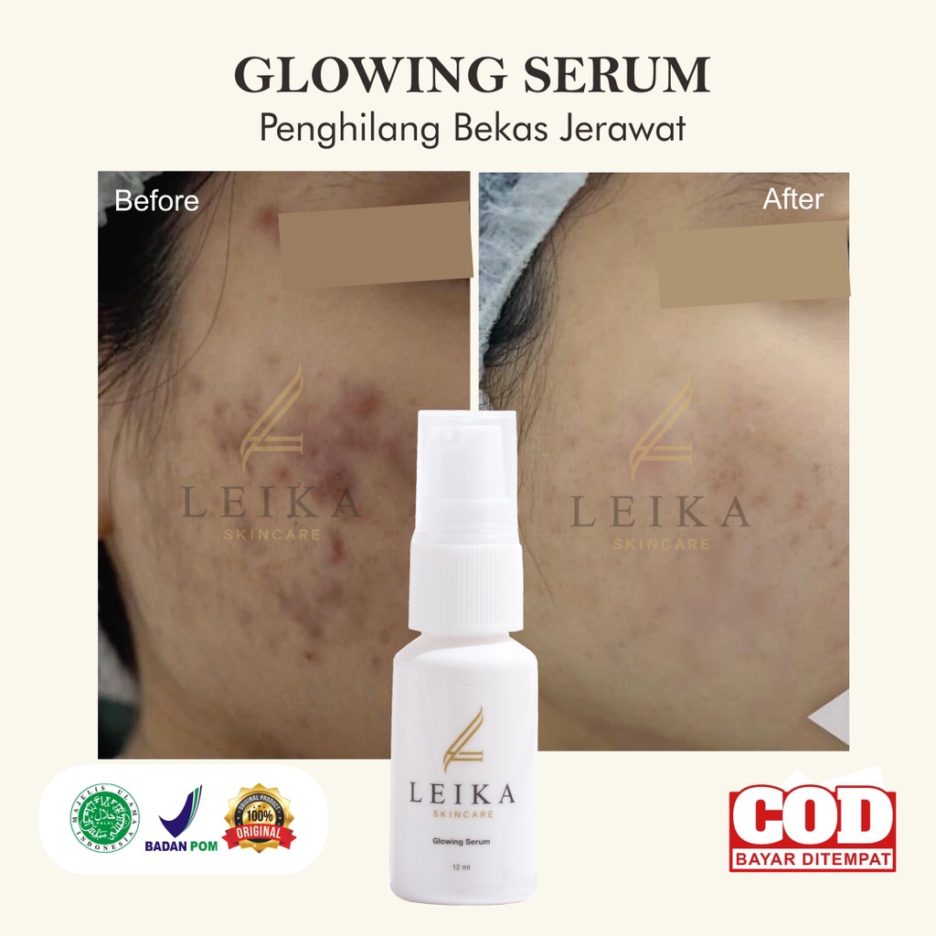 Serum Penghilang Bekas Jerawat Bopeng Ampuh Menghilangkan Bekas Jerawat Penghilang Bopeng Penghilang