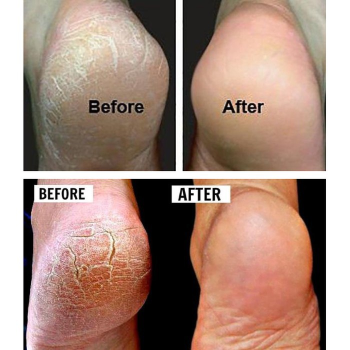 KAOS KAKI SOFTGELS ANTI KULIT KERING PECAH PECAH Halus Mulus