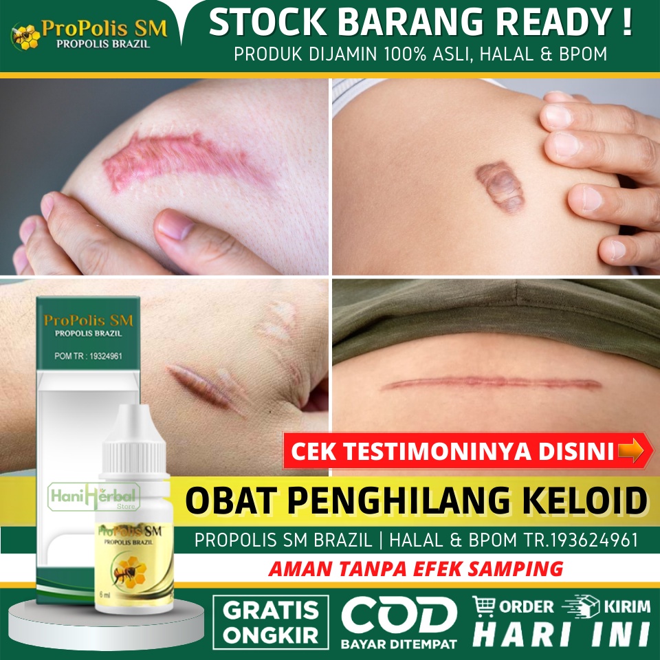 OBAT KELOID 100% ALAMI - Obat Penghilang Keloid, Salep Keloid, Penghilang Keloid di Wajah / Perut / 