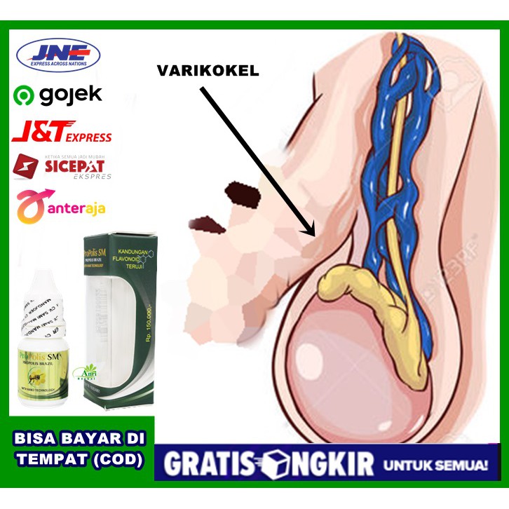 Propolis SM Brazil - Obat Varises Buah Zakar, Varikokel, Zakar Bengkak Sebelah Sakit Buang Air Kecil